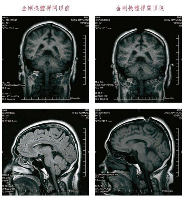 祿東贊法王修境行法「金剛換體禪」前後,MRI核磁共振儀腦斷層掃瞄檢測照片